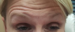 Woman's forehead before Botox