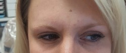 Smooth forehead after Botox treatment