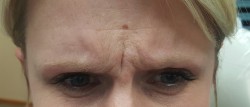 Woman's forehead after Botox