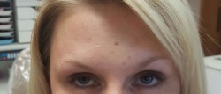 Forehead before Botox treatment