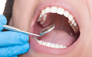 Closeup of teeth during restoration