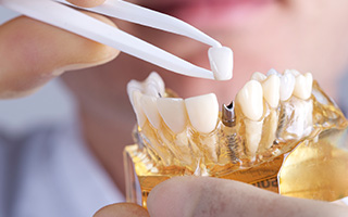Model of implant supported crown