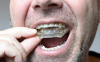 Man placing a nightguard for teeth grinding