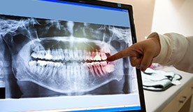 Panoramic dental x-rays