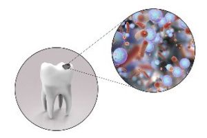 Tooth with a close-up of cavity-causing bacteria
